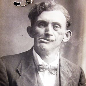 A fractured face photographer unknown Bertram Byrnes after surgery. National Archives of Australia