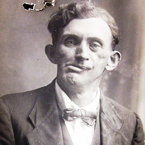 A fractured face photographer unknown Bertram Byrnes after surgery. National Archives of Australia