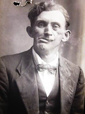 A fractured face photographer unknown Bertram Byrnes after surgery. National Archives of Australia